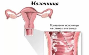 Лечение молочницы у женщин: препараты — недорогие, но эффективные