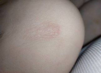 Шершавые пятна на теле у ребенка